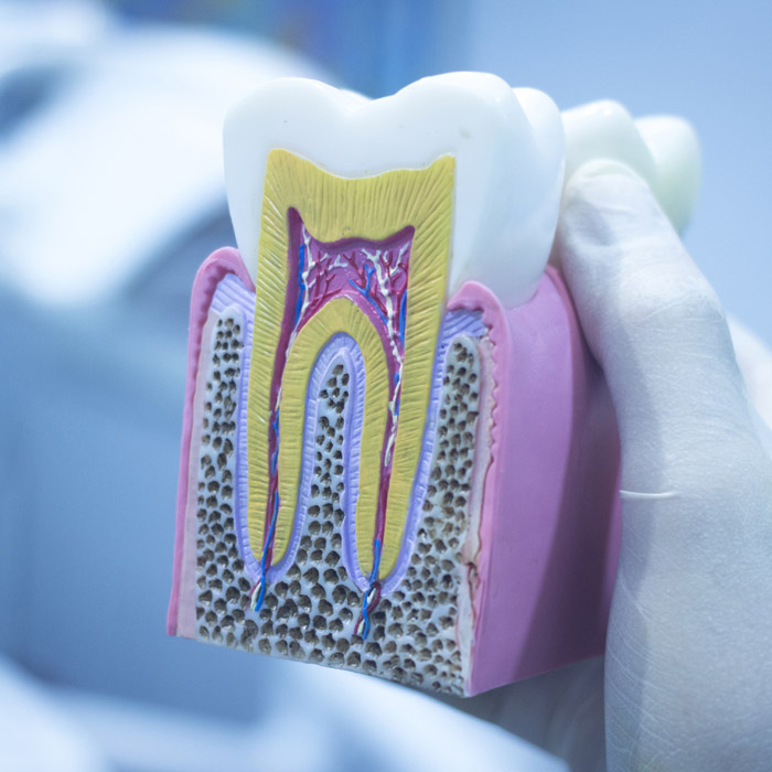 wurzelkanalbehandlung